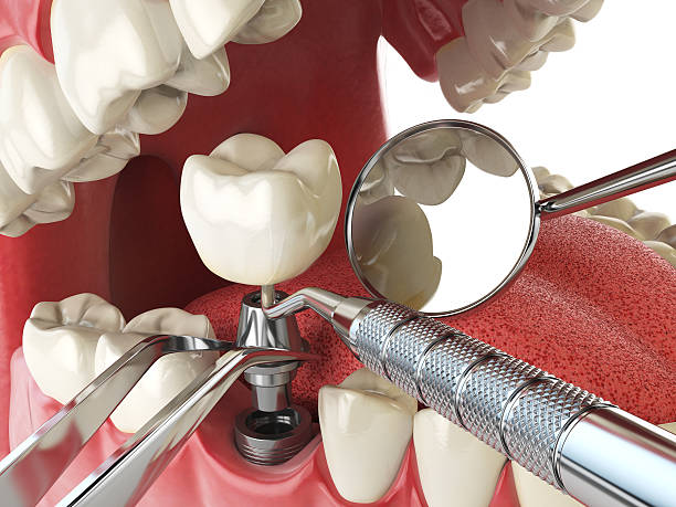 Best Broken or Cracked Tooth Emergency Dentist in Mount Pleasant, SC
